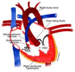 Aortic Arch in Heart 