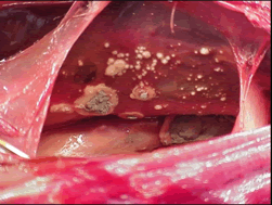 Aspergillus Fumigatus