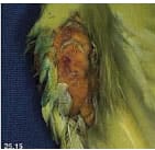 Image 58: A 10-year-old female cockatiel was presented for feather-picking associated with the right carpus of the wing. A diffuse (spread out), firm, yellow mass was noted on physical examination. The xanthoma was surgically excised.