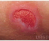 Granulomatous tissue in wound healing