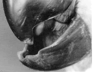 Mandibular prognathism