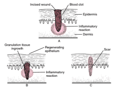 Wound Healing by First, Second, And Third Intention 