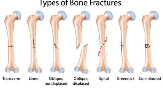Fracture types